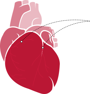 Cum de a salva stentare infarct miocardic