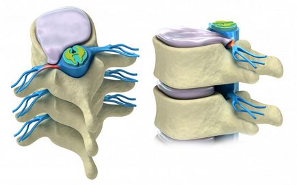 Tratament Herniile intervertebrale fără o intervenție chirurgicală