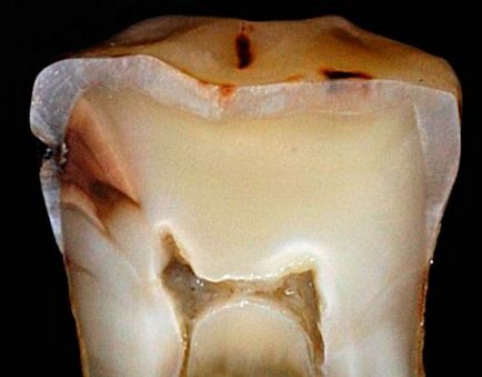 Cariile de dentinei
