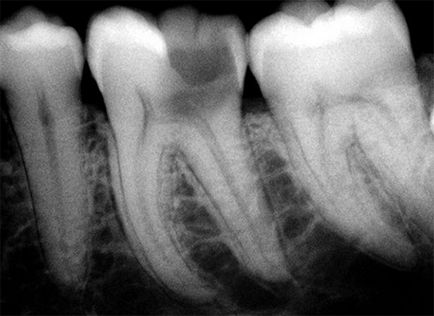 Cariile de dentinei