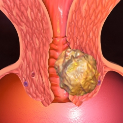 Tratamentul chisturi endocervical