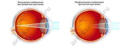 Tratamentul cataractei, o intervenție chirurgicală pentru a înlocui cristalinul ochiului, preturi, facoemulsificare cu implantare