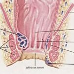 Comentarii pentru tratamentul hemoroizilor
