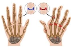 tratamentul polyosteoarthrosis