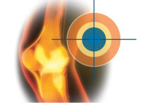 tratamentul polyosteoarthrosis