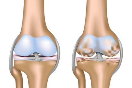 tratamentul polyosteoarthrosis