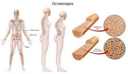 Medicament pentru tratamentul osteoporozei
