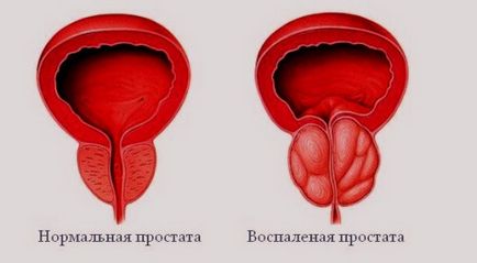 Simptomele prostatita la bărbați