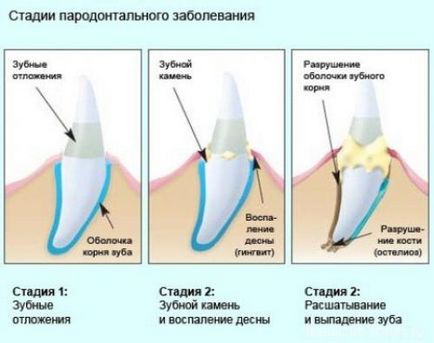 gradul parodontită