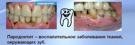 gradul parodontită