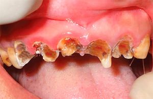 Cariile de dentinei