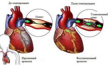 Miocardica la stentarea