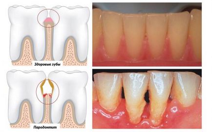 gradul parodontită