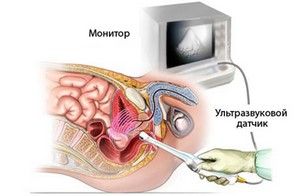 prostata si a vezicii urinare cu ultrasunete - modul in care acestea petrec și cum să se pregătească
