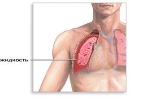 Lichidul din efectul plămâni cauzele și tratamentul acumulării de apă în plămâni, lichidul din plamani cu