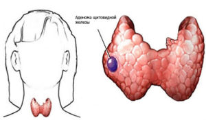 Simptomele tiroidiană adenom, diagnostic, tratament