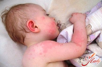 Alergiile la copii - tratament, Simptome