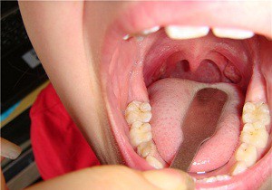 Durere în gât, fără simptome de febră și tratamentul unui copil bolnav