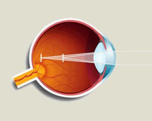 simptome astigmatismul foto, cauze si tratament