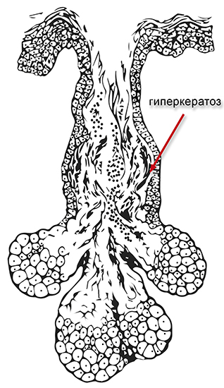 peroxid de benzoil - de droguri acnee alegerea