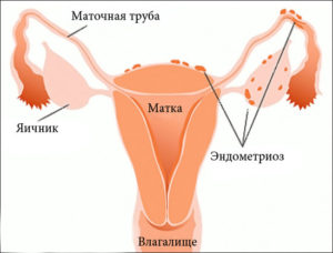 Chisturile mai periculoase pe ovarele femeii în detaliu cu privire la consecințele