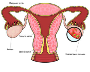 Chisturile mai periculoase pe ovarele femeii în detaliu cu privire la consecințele