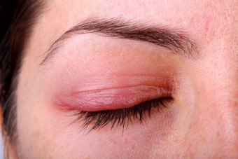 mancarimi ale ochilor cauze, simptome și tratament