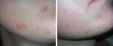 Ce este un exfoliant pentru față și corp, cum funcționează, eficiența (peeling-ul exfoliant) Ce este un exfoliant pentru față și corp, cum funcționează, eficiență