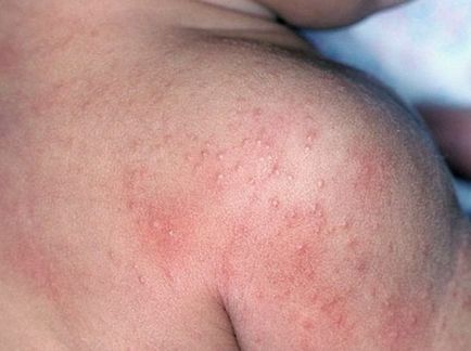 Dermatită (fotografii) - simptome și tratament la adulți
