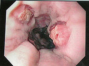 Endoscopie - un