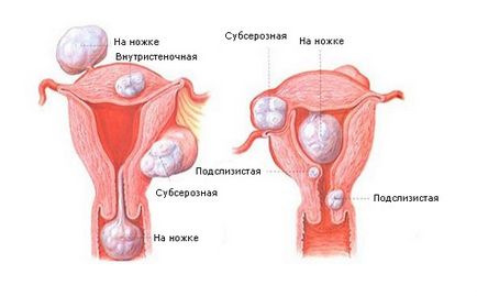 fibrom uterin cauze, semne și simptome, tratament
