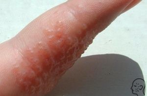 Herpes pe mâini și degete - cauze, simptome si tratament (foto)
