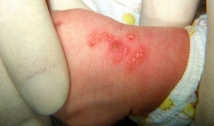 Herpes pe cauze mâini, simptome (foto), cum să scape