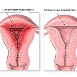 Simptomele hiperplaziei endometriale și tratamentul de remedii populare
