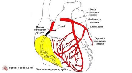 peretele din spate infarct miocardic