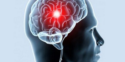 Accident vascular cerebral și consecințele sale - care sunt șansele de supraviețuire