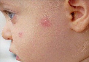 pete roșii pe corpul fotografiei pentru copii cu o descriere a simptomelor de patologii