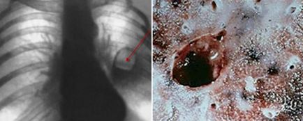 Tratamentul infecțiilor stafilococice