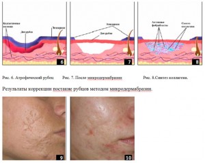 Microdermabraziunea proceduri faciale ca indicații și contraindicații