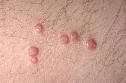 Scoici pe fata a ceea ce este molluscum contagiosum la adulți cum să scape de (contagioase) Scoici pe fata a ceea ce este molluscum contagiosum la adulți, cum să scape
