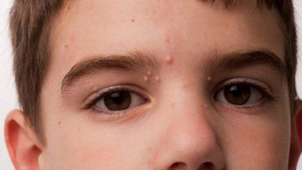 Scoici pe fata a ceea ce este molluscum contagiosum la adulți cum să scape de (feței) Scoici pe fata a ceea ce este molluscum contagiosum la adulți, cum să scape