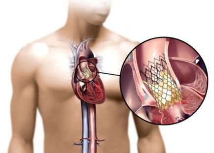 Cât de periculos este un murmur cardiac