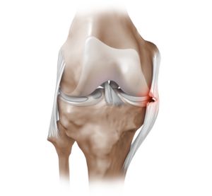 durere acută în genunchi - de ce apare, și pulsatilă bruscă în articulația genunchiului
