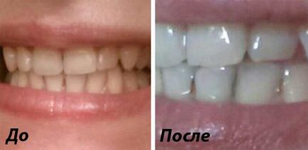 Albirea dinților fotografii înainte și după