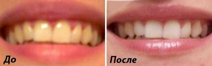 Albirea dinților fotografii înainte și după