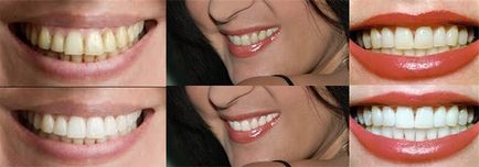 Albirea dinților la domiciliu - cele mai bune metode și recenzii