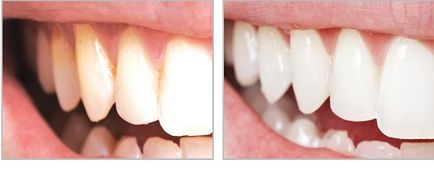 lustruire dinți - o fotografie înainte și după, prețurile pentru lustruire și măcinare a dintilor - portal stomatologic