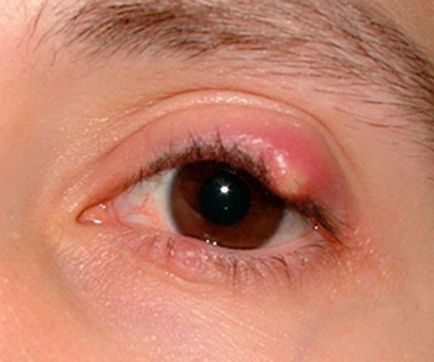 Un comedon pe pleoapa - ochi, alb, superior și inferior, de tratament, în interiorul