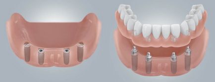 implant protetic cu absenta dinți complet (detașabil maxilarului proteză) implant protetic în absența dinților