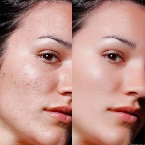 Procedura de peeling facial